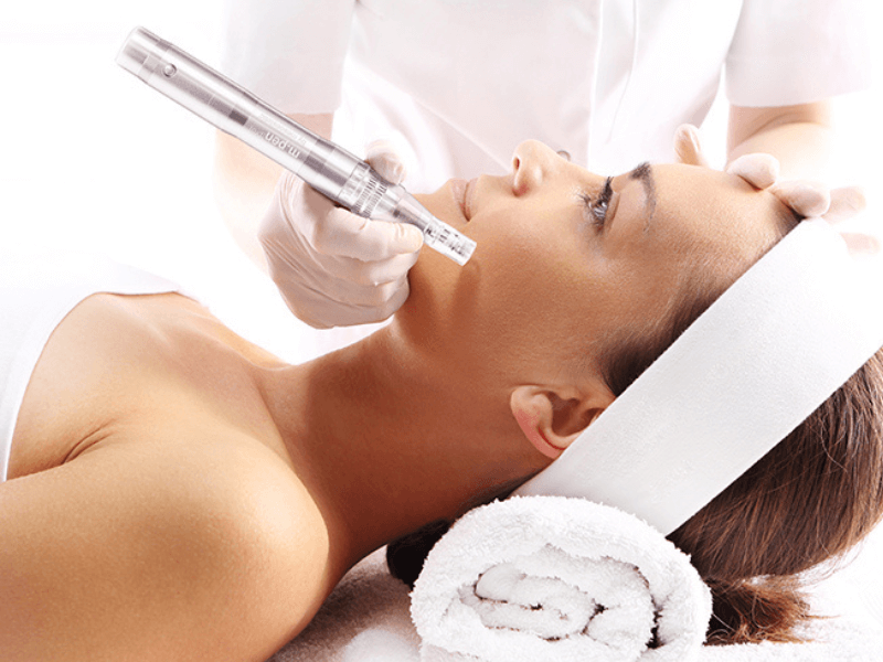 Microneedling 800x600 4 1